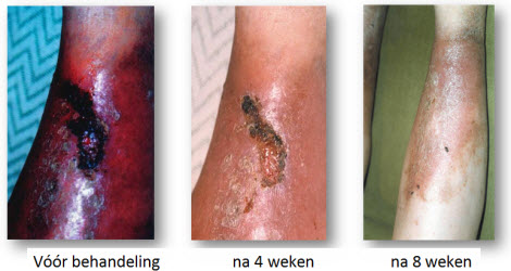Diabetische Ulcus Cruris Genezing