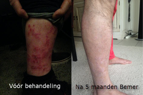 Psoriasis voor en na Bemer behandeling